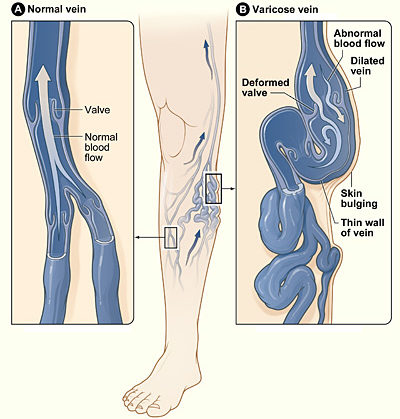 Homeopathic Treatments For Varicose Veins